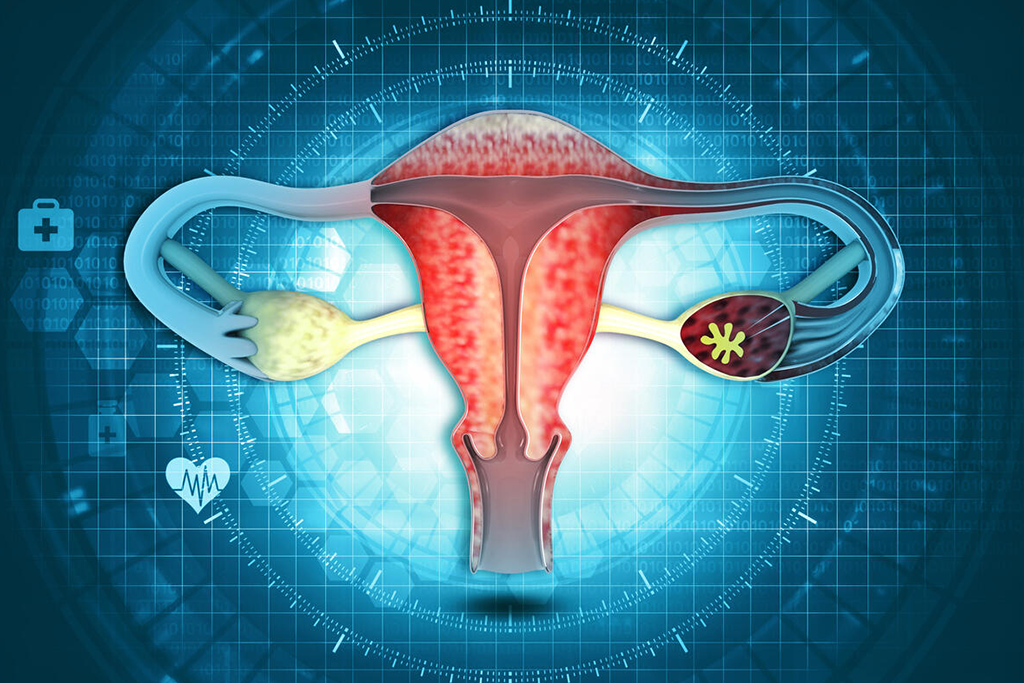 Gynecological Cancers