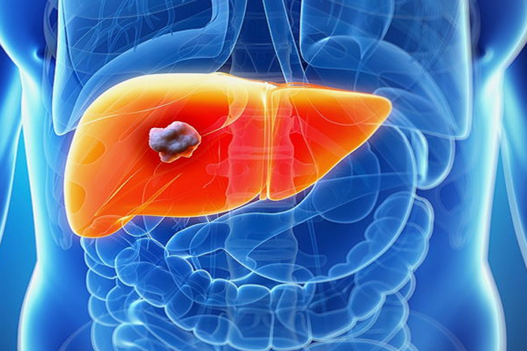 Liver cancer