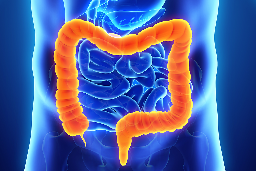 Colon Surgery