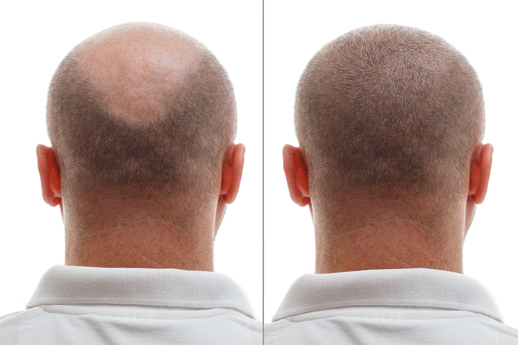 Hair Transplantation