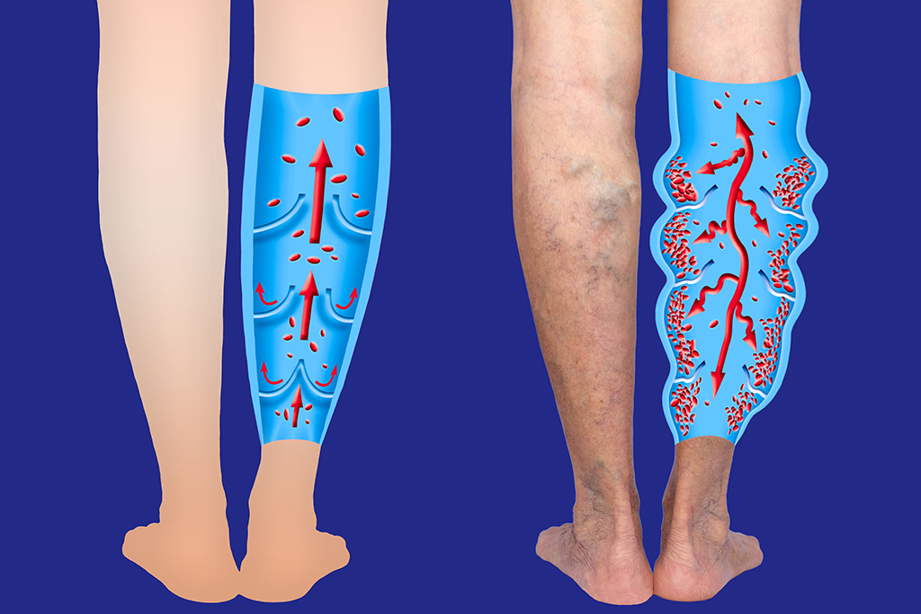 Varicose Veins Treatment