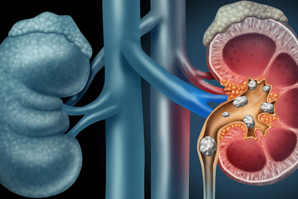 Urinary System Stone Surgery