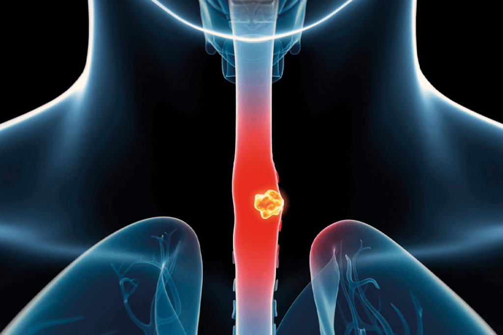 Esophageal Cancer